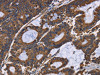 The image on the left is immunohistochemistry of paraffin-embedded Human colon cancer tissue using CSB-PA648744 (ADRBK2 Antibody) at dilution 1/40, on the right is treated with fusion protein. (Original magnification: ×200)