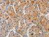 The image on the left is immunohistochemistry of paraffin-embedded Human liver cancer tissue using CSB-PA999801 (PRKCE Antibody) at dilution 1/50, on the right is treated with fusion protein. (Original magnification: ×200)