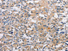 The image on the left is immunohistochemistry of paraffin-embedded Human thyroid cancer tissue using CSB-PA999801 (PRKCE Antibody) at dilution 1/50, on the right is treated with fusion protein. (Original magnification: ×200)