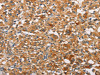 The image on the left is immunohistochemistry of paraffin-embedded Human thyroid cancer tissue using CSB-PA437351 (PRKCE Antibody) at dilution 1/30, on the right is treated with fusion protein. (Original magnification: ×200)