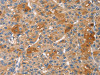 The image on the left is immunohistochemistry of paraffin-embedded Human liver cancer tissue using CSB-PA437351 (PRKCE Antibody) at dilution 1/30, on the right is treated with fusion protein. (Original magnification: ×200)
