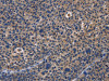 The image on the left is immunohistochemistry of paraffin-embedded Human liver cancer tissue using CSB-PA575950 (PRKCD Antibody) at dilution 1/30, on the right is treated with fusion protein. (Original magnification: ×200)