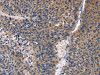 The image on the left is immunohistochemistry of paraffin-embedded Human liver cancer tissue using CSB-PA282230 (PRKCD Antibody) at dilution 1/30, on the right is treated with fusion protein. (Original magnification: ×200)