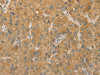 The image on the left is immunohistochemistry of paraffin-embedded Human liver cancer tissue using CSB-PA148761 (PRPSAP1 Antibody) at dilution 1/80, on the right is treated with fusion protein. (Original magnification: ×200)