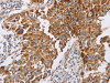 The image on the left is immunohistochemistry of paraffin-embedded Human lung cancer tissue using CSB-PA173685 (GUCY1A3 Antibody) at dilution 1/40, on the right is treated with fusion protein. (Original magnification: ×200)