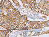 The image on the left is immunohistochemistry of paraffin-embedded Human breast cancer tissue using CSB-PA173685 (GUCY1A3 Antibody) at dilution 1/40, on the right is treated with fusion protein. (Original magnification: ×200)