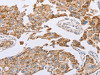 The image on the left is immunohistochemistry of paraffin-embedded Human lung cancer tissue using CSB-PA558643 (GUCY1A3 Antibody) at dilution 1/30, on the right is treated with fusion protein. (Original magnification: ×200)