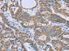 The image on the left is immunohistochemistry of paraffin-embedded Human thyroid cancer tissue using CSB-PA558643 (GUCY1A3 Antibody) at dilution 1/30, on the right is treated with fusion protein. (Original magnification: ×200)