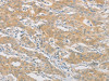 The image on the left is immunohistochemistry of paraffin-embedded Human gastic cancer tissue using CSB-PA072130 (HIPK4 Antibody) at dilution 1/30, on the right is treated with fusion protein. (Original magnification: ×200)
