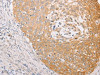 The image on the left is immunohistochemistry of paraffin-embedded Human cervical cancer tissue using CSB-PA907425 (MARK1 Antibody) at dilution 1/30, on the right is treated with fusion protein. (Original magnification: ×200)