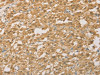 The image on the left is immunohistochemistry of paraffin-embedded Human thyroid cancer tissue using CSB-PA145596 (PGK2 Antibody) at dilution 1/50, on the right is treated with fusion protein. (Original magnification: ×200)