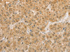 The image on the left is immunohistochemistry of paraffin-embedded Human liver cancer tissue using CSB-PA145596 (PGK2 Antibody) at dilution 1/50, on the right is treated with fusion protein. (Original magnification: ×200)
