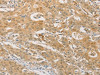 The image on the left is immunohistochemistry of paraffin-embedded Human gastic cancer tissue using CSB-PA191316 (PGK2 Antibody) at dilution 1/50, on the right is treated with fusion protein. (Original magnification: ×200)