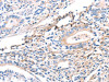 The image on the left is immunohistochemistry of paraffin-embedded Human gastric cancer tissue using CSB-PA146937 (TWF2 Antibody) at dilution 1/40, on the right is treated with fusion protein. (Original magnification: ×200)