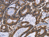 The image on the left is immunohistochemistry of paraffin-embedded Human colon cancer tissue using CSB-PA030360 (EPHB6 Antibody) at dilution 1/40, on the right is treated with fusion protein. (Original magnification: ×200)