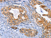 The image on the left is immunohistochemistry of paraffin-embedded Human cervical cancer tissue using CSB-PA579873 (MUSK Antibody) at dilution 1/30, on the right is treated with fusion protein. (Original magnification: ×200)