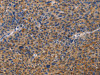 The image on the left is immunohistochemistry of paraffin-embedded Human liver cancer tissue using CSB-PA989887 (MUSK Antibody) at dilution 1/40, on the right is treated with fusion protein. (Original magnification: ×200)