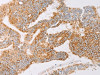 The image on the left is immunohistochemistry of paraffin-embedded Human colon cancer tissue using CSB-PA258399 (YARS2 Antibody) at dilution 1/30, on the right is treated with fusion protein. (Original magnification: ×200)