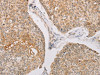 The image on the left is immunohistochemistry of paraffin-embedded Human lung cancer tissue using CSB-PA158011 (STK40 Antibody) at dilution 1/40, on the right is treated with fusion protein. (Original magnification: ×200)