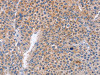 The image on the left is immunohistochemistry of paraffin-embedded Human liver cancer tissue using CSB-PA285585 (PLK1 Antibody) at dilution 1/20, on the right is treated with fusion protein. (Original magnification: ×200)
