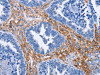 The image on the left is immunohistochemistry of paraffin-embedded Human ovarian cancer tissue using CSB-PA107067 (PLK1 Antibody) at dilution 1/15, on the right is treated with fusion protein. (Original magnification: ×200)