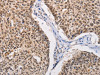 The image on the left is immunohistochemistry of paraffin-embedded Human lung cancer tissue using CSB-PA443599 (MYLK3 Antibody) at dilution 1/30, on the right is treated with fusion protein. (Original magnification: ×200)