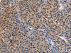 The image on the left is immunohistochemistry of paraffin-embedded Human liver cancer tissue using CSB-PA784556 (MAP3K13 Antibody) at dilution 1/40, on the right is treated with fusion protein. (Original magnification: ×200)
