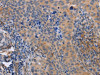 The image on the left is immunohistochemistry of paraffin-embedded Human cervical cancer tissue using CSB-PA784556 (MAP3K13 Antibody) at dilution 1/40, on the right is treated with fusion protein. (Original magnification: ×200)