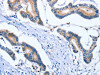 The image on the left is immunohistochemistry of paraffin-embedded Human colon cancer tissue using CSB-PA275027 (PLK3 Antibody) at dilution 1/30, on the right is treated with fusion protein. (Original magnification: ×200)