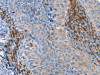 The image on the left is immunohistochemistry of paraffin-embedded Human cervical cancer tissue using CSB-PA273685 (PLK3 Antibody) at dilution 1/40, on the right is treated with fusion protein. (Original magnification: ×200)