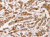 The image on the left is immunohistochemistry of paraffin-embedded Human breast cancer tissue using CSB-PA141591 (AK2 Antibody) at dilution 1/30, on the right is treated with fusion protein. (Original magnification: ×200)