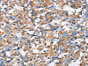 The image on the left is immunohistochemistry of paraffin-embedded Human thyroid cancer tissue using CSB-PA912667 (PFKP Antibody) at dilution 1/50, on the right is treated with fusion protein. (Original magnification: ×200)