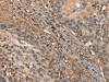 The image on the left is immunohistochemistry of paraffin-embedded Human cervical cancer tissue using CSB-PA687442 (HK3 Antibody) at dilution 1/40, on the right is treated with fusion protein. (Original magnification: ×200)