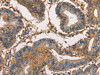 The image on the left is immunohistochemistry of paraffin-embedded Human colon cancer tissue using CSB-PA568564 (HK3 Antibody) at dilution 1/40, on the right is treated with fusion protein. (Original magnification: ×200)