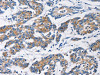 The image on the left is immunohistochemistry of paraffin-embedded Human colon cancer tissue using CSB-PA093794 (HK1 Antibody) at dilution 1/50, on the right is treated with fusion protein. (Original magnification: ×200)