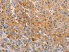 The image on the left is immunohistochemistry of paraffin-embedded Human liver cancer tissue using CSB-PA133010 (OLR1 Antibody) at dilution 1/50, on the right is treated with fusion protein. (Original magnification: ×200)