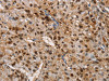 The image on the left is immunohistochemistry of paraffin-embedded Human liver cancer tissue using CSB-PA155145 (TSPEAR Antibody) at dilution 1/50, on the right is treated with fusion protein. (Original magnification: ×200)