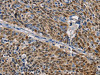 The image on the left is immunohistochemistry of paraffin-embedded Human lung cancer tissue using CSB-PA174920 (GSTA2 Antibody) at dilution 1/50, on the right is treated with fusion protein. (Original magnification: ×200)
