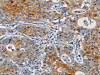 The image on the left is immunohistochemistry of paraffin-embedded Human gastic cancer tissue using CSB-PA974108 (GSTA2 Antibody) at dilution 1/50, on the right is treated with fusion protein. (Original magnification: ×200)
