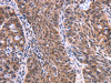 The image on the left is immunohistochemistry of paraffin-embedded Human ovarian cancer tissue using CSB-PA554018 (EIF2AK4 Antibody) at dilution 1/50, on the right is treated with fusion protein. (Original magnification: ×200)