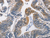 The image on the left is immunohistochemistry of paraffin-embedded Human colon cancer tissue using CSB-PA905158 (PGK1 Antibody) at dilution 1/50, on the right is treated with fusion protein. (Original magnification: ×200)