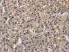 The image on the left is immunohistochemistry of paraffin-embedded Human liver cancer tissue using CSB-PA547426 (PGK1 Antibody) at dilution 1/40, on the right is treated with fusion protein. (Original magnification: ×200)