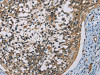 The image on the left is immunohistochemistry of paraffin-embedded Human cervical cancer tissue using CSB-PA181338 (CSNK1E Antibody) at dilution 1/60, on the right is treated with fusion protein. (Original magnification: ×200)