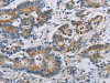 The image on the left is immunohistochemistry of paraffin-embedded Human colon cancer tissue using CSB-PA181338 (CSNK1E Antibody) at dilution 1/60, on the right is treated with fusion protein. (Original magnification: ×200)