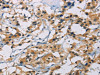 The image on the left is immunohistochemistry of paraffin-embedded Human thyroid cancer tissue using CSB-PA156748 (CSNK1E Antibody) at dilution 1/30, on the right is treated with fusion protein. (Original magnification: ×200)