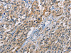 The image on the left is immunohistochemistry of paraffin-embedded Human esophagus cancer tissue using CSB-PA016670 (CBR1 Antibody) at dilution 1/40, on the right is treated with fusion protein. (Original magnification: ×200)