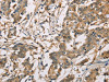 The image on the left is immunohistochemistry of paraffin-embedded Human colon cancer tissue using CSB-PA232262 (CBR1 Antibody) at dilution 1/40, on the right is treated with fusion protein. (Original magnification: ×200)