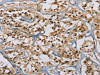 The image on the left is immunohistochemistry of paraffin-embedded Human thyroid cancer tissue using CSB-PA281732 (ACVR1 Antibody) at dilution 1/60, on the right is treated with fusion protein. (Original magnification: ×200)