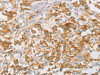 The image on the left is immunohistochemistry of paraffin-embedded Human thyroid cancer tissue using CSB-PA576064 (NPPB Antibody) at dilution 1/30, on the right is treated with fusion protein. (Original magnification: ×200)