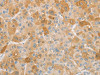 The image on the left is immunohistochemistry of paraffin-embedded Human liver cancer tissue using CSB-PA576064 (NPPB Antibody) at dilution 1/30, on the right is treated with fusion protein. (Original magnification: ×200)